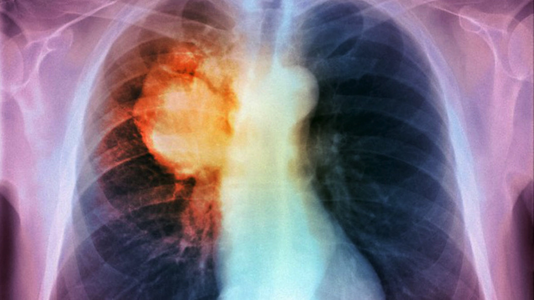 Tumore al polmone nei non fumatori, uno studio sulle cause