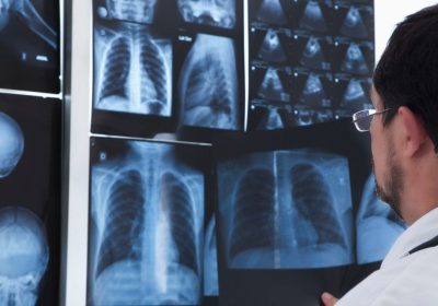 Mesotelioma, quali sono i legami del tumore con l’amianto