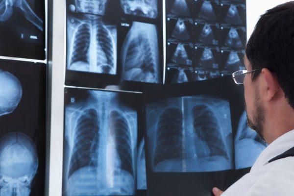 Mesotelioma, quali sono i legami del tumore con l’amianto