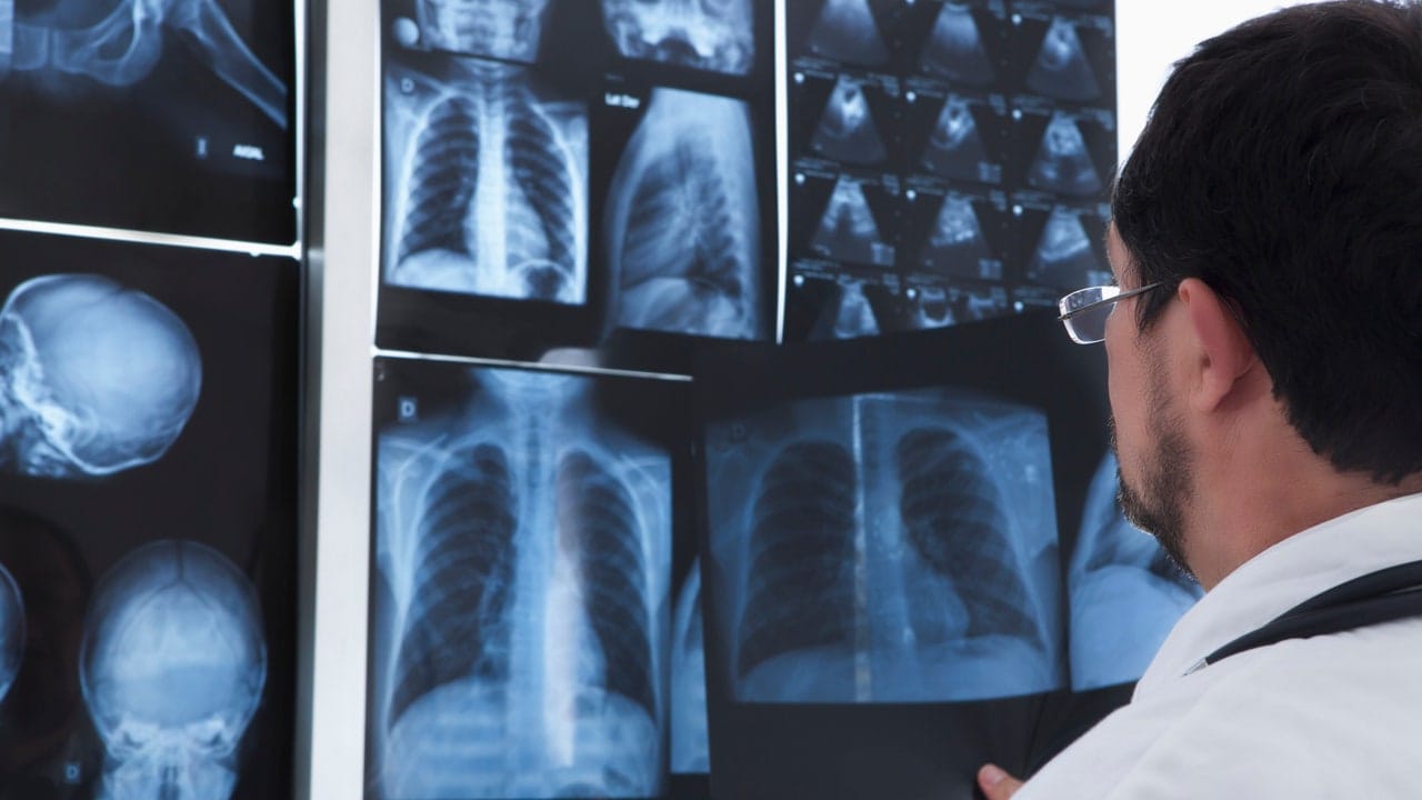 Mesotelioma, quali sono i legami del tumore con l’amianto