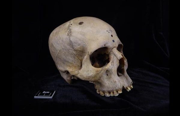 Antico Egitto, scoperto un cranio con segni di interventi chirurgici per un tumore al cervello