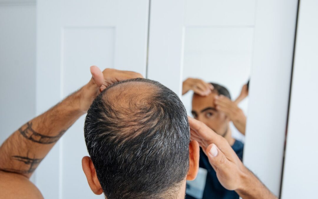 Calvizie, dallo zucchero naturale una nuova arma per curarla