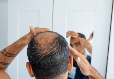 Calvizie, dallo zucchero naturale una nuova arma per curarla