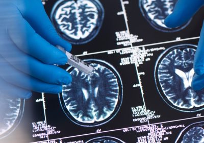 Alzheimer, gli Stati Uniti hanno approvato un nuovo farmaco