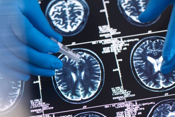 Alzheimer, gli Stati Uniti hanno approvato un nuovo farmaco