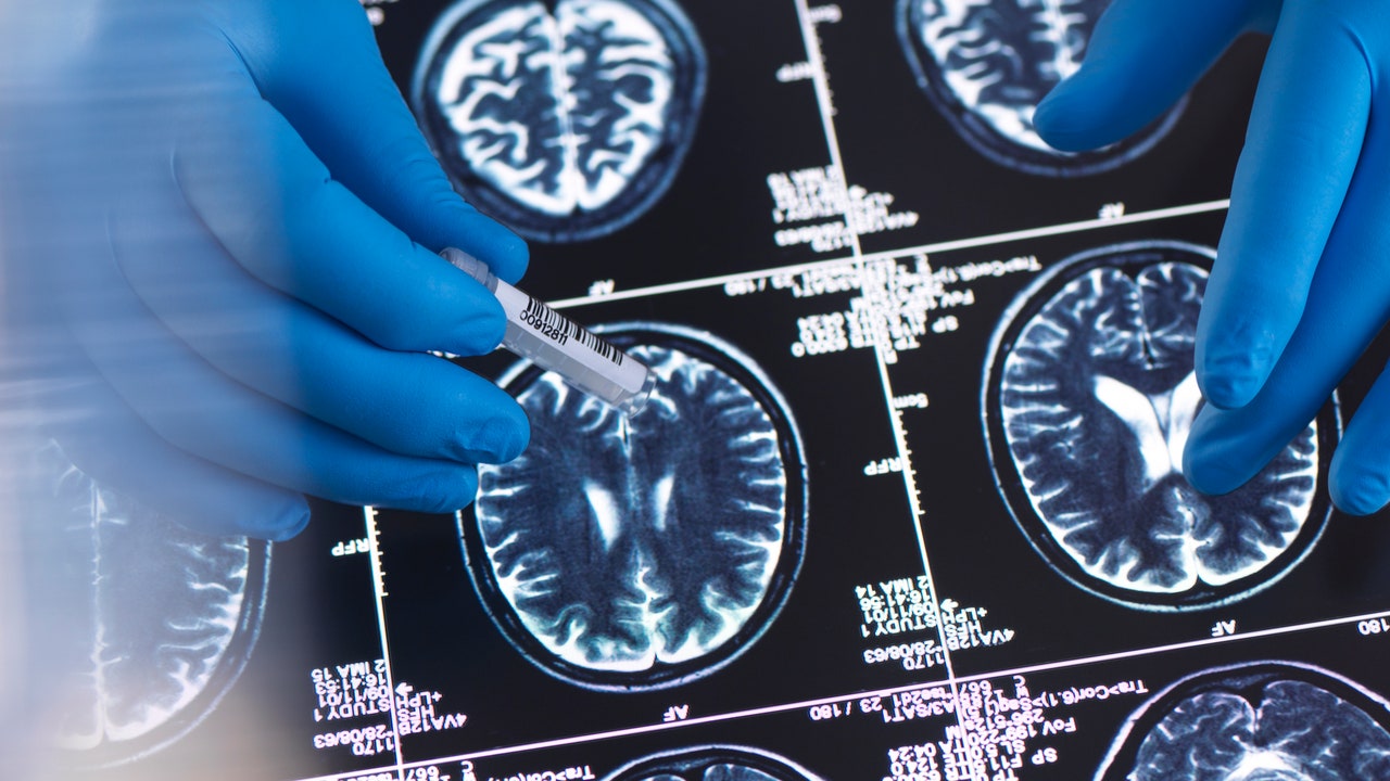 Alzheimer, gli Stati Uniti hanno approvato un nuovo farmaco