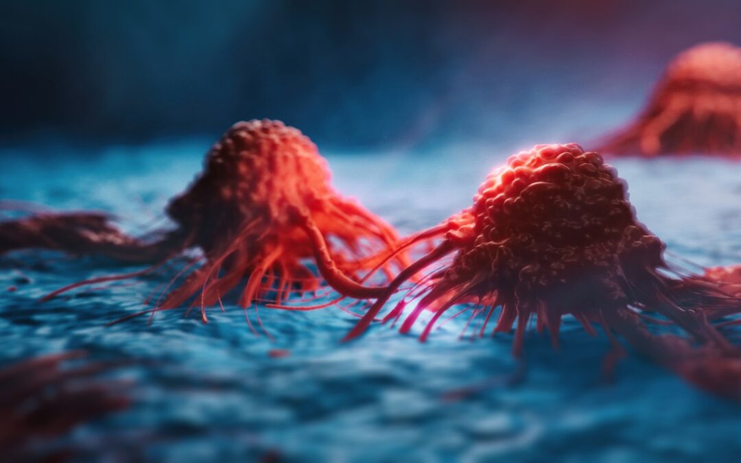 Il tumore al pancreas spegne un gene chiave per poter crescere