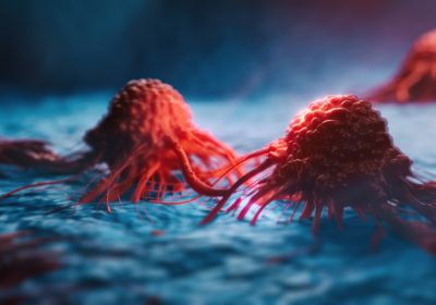 Il tumore al pancreas spegne un gene chiave per poter crescere