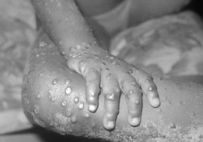 Vaiolo delle scimmie, perché questa ondata è diversa