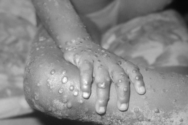 Vaiolo delle scimmie, perché questa ondata è diversa