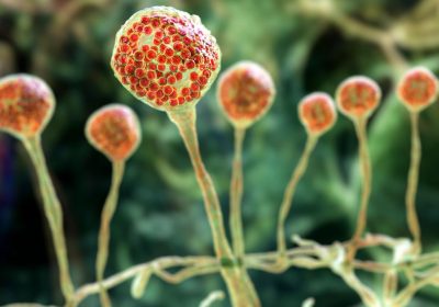 Malattia del fungo nero, cos’è l’infezione rara ma molto pericolosa