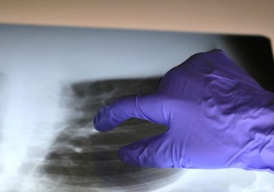 Erionite, scoperto il possibile meccanismo per cui la fibra è così tossica