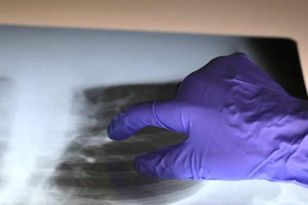 Erionite, scoperto il possibile meccanismo per cui la fibra è così tossica