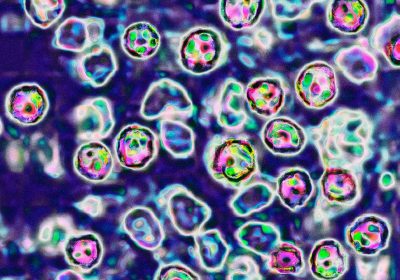 Morbillo, gli effetti e perché può essere letale