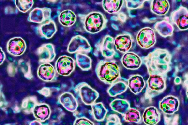 Morbillo, gli effetti e perché può essere letale