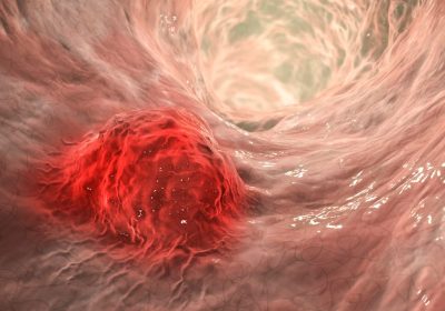 Tumore al colon in aumento tra gli under 50, la causa potrebbe essere una tossina