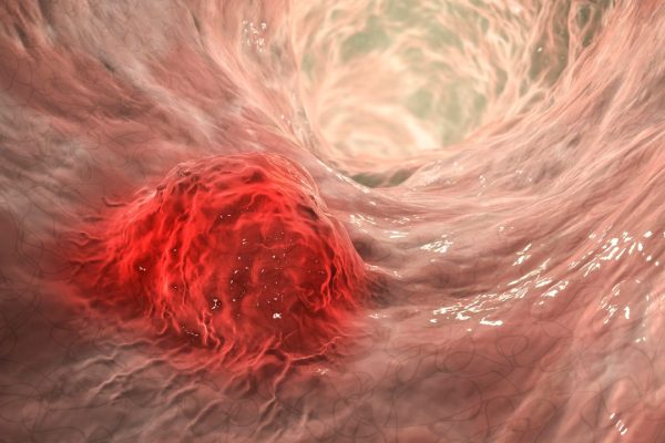 Tumore al colon in aumento tra gli under 50, la causa potrebbe essere una tossina