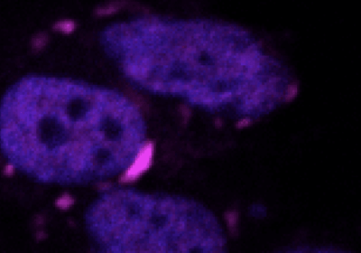Malattie neurodegenerative, arriva l’algoritmo che fiuta le proteine tossiche