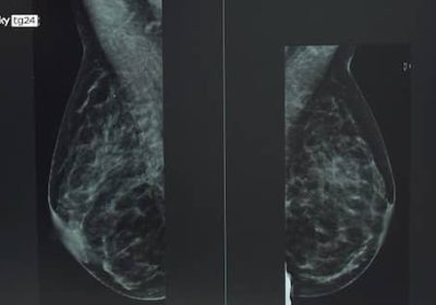 Cancro al seno, Health Triage sviluppa uno screening con I.A.