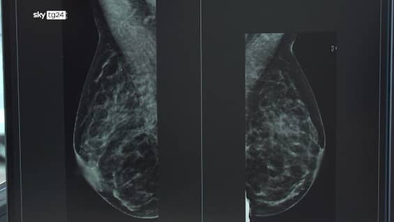Cancro al seno, Health Triage sviluppa uno screening con I.A.
