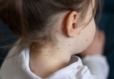 Casi di morbillo, nel 2024 in Europa sono aumentati drammaticamente
