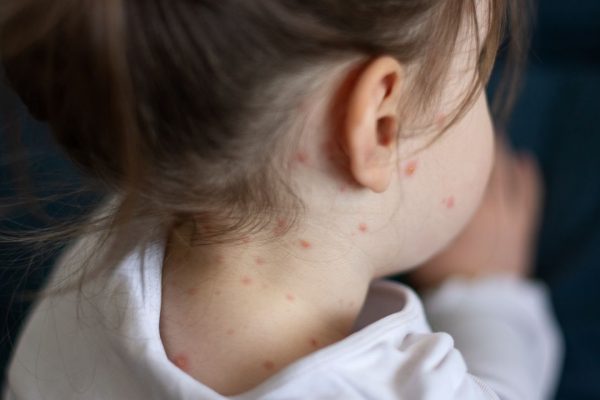 Casi di morbillo, nel 2024 in Europa sono aumentati drammaticamente