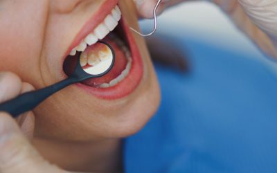 Batterio nelle gengive che può arrivare fino al cuore, come riesce ad ingannare le difese immunitarie