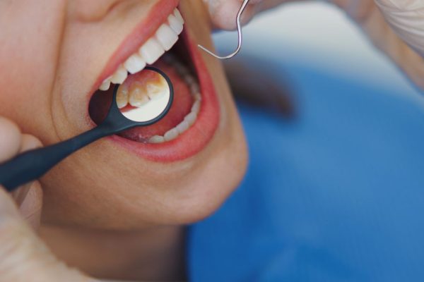 Batterio nelle gengive che può arrivare fino al cuore, come riesce ad ingannare le difese immunitarie