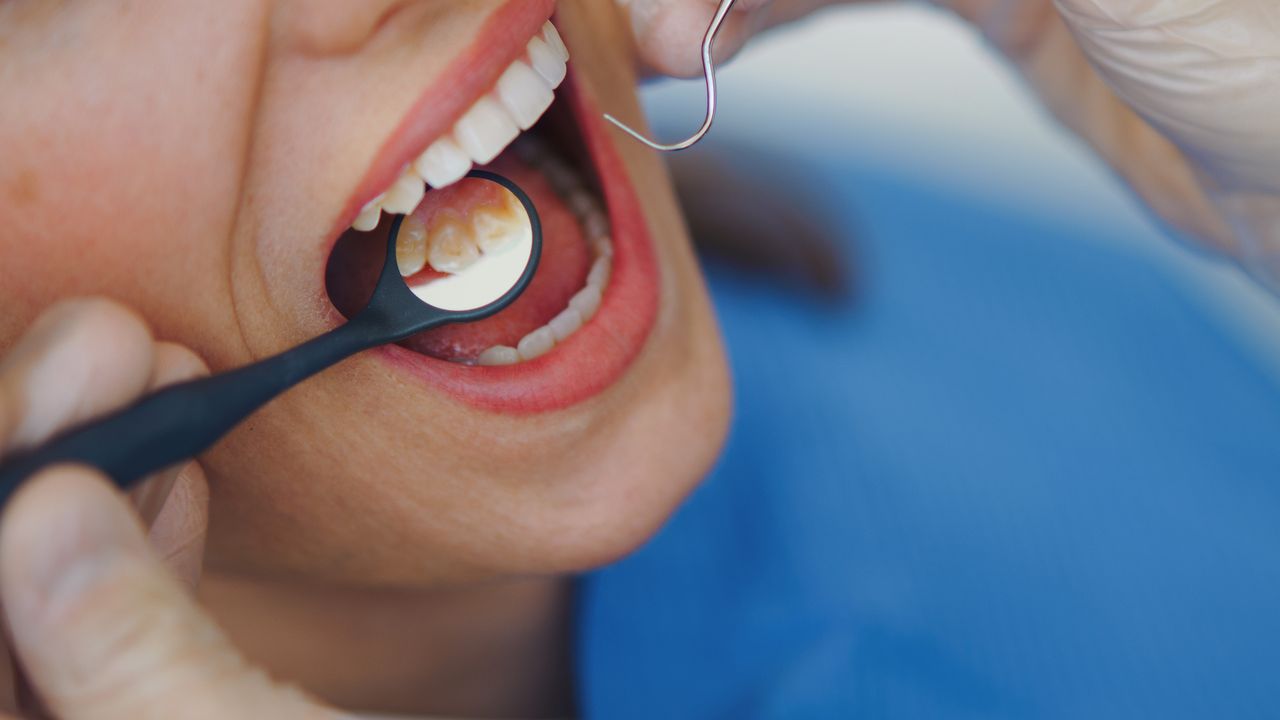 Batterio nelle gengive che può arrivare fino al cuore, come riesce ad ingannare le difese immunitarie