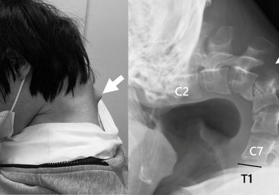 Usate troppo lo smartphone? Attenti al collo, potreste finire sotto i ferri