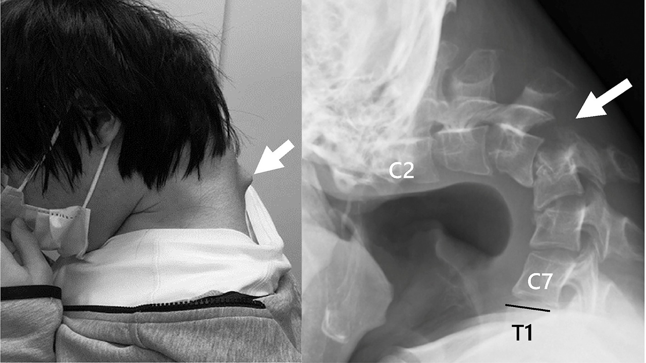 Usate troppo lo smartphone? Attenti al collo, potreste finire sotto i ferri