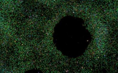 Cellule staminali, nasce la prima banca per lo studio dell’ Alzheimer a disposizione dei ricercatori di tutto il mondo