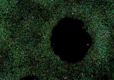 Cellule staminali, nasce la prima banca per lo studio dell’ Alzheimer a disposizione dei ricercatori di tutto il mondo