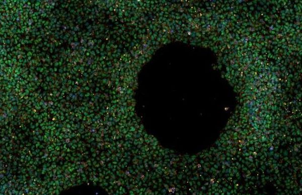 Cellule staminali, nasce la prima banca per lo studio dell’ Alzheimer a disposizione dei ricercatori di tutto il mondo