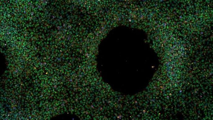 Cellule staminali, nasce la prima banca per lo studio dell’ Alzheimer a disposizione dei ricercatori di tutto il mondo