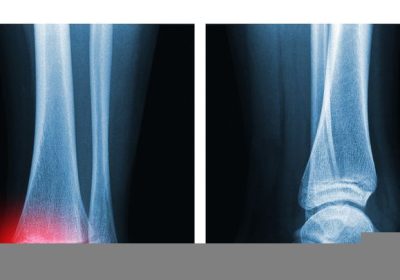 Pistola con colla a caldo, un gruppo di ricerca ne ha ideata una modificata per favorire la rigenerazione delle ossa rotte