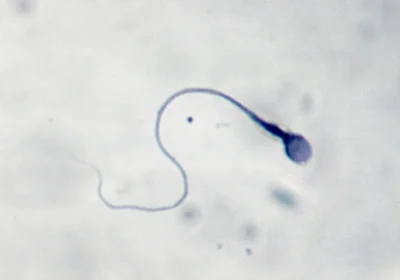 La prima gravidanza al mondo ottenuta grazie all’intelligenza artificiale capace di scovare gli spermatozoi vitali (e a un robot)