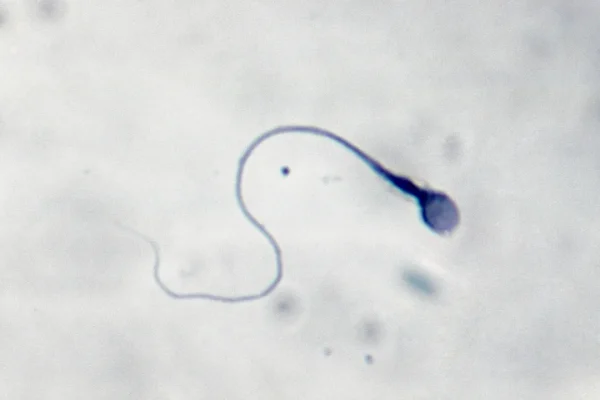 La prima gravidanza al mondo ottenuta grazie all’intelligenza artificiale capace di scovare gli spermatozoi vitali (e a un robot)