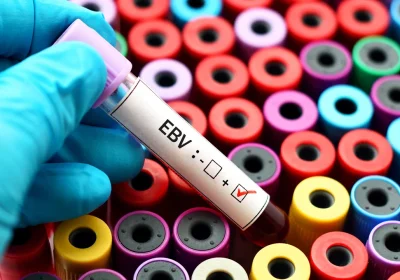 La causa del lupus eritematoso sistemico è stata finalmente scoperta e si tratta di un virus che quasi tutti noi abbiamo latente