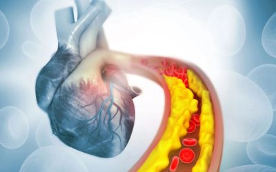 Terapia genica 'one-shot' abbatte colesterolo e trigliceridi: prima sperimentazione umana riuscita