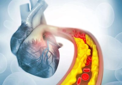 Terapia genica 'one-shot' abbatte colesterolo e trigliceridi: prima sperimentazione umana riuscita