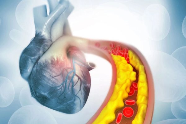 Terapia genica 'one-shot' abbatte colesterolo e trigliceridi: prima sperimentazione umana riuscita