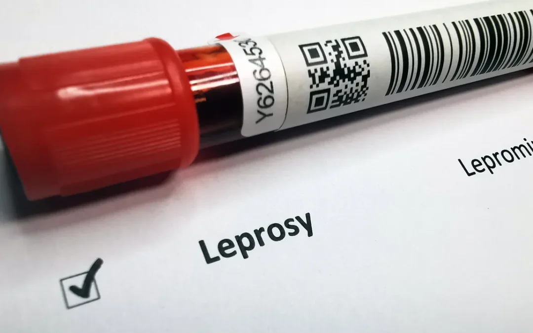 Casi di lebbra sono stati segnalati in Romania e Croazia, come si manifesta la malattia (e in Italia è diffusa?)