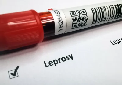 Casi di lebbra sono stati segnalati in Romania e Croazia, come si manifesta la malattia (e in Italia è diffusa?)
