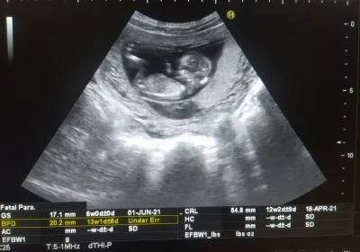 Pfas nei feti, la situazione è più grave di quanto immaginassimo