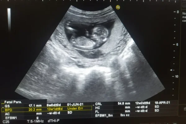 Pfas nei feti, la situazione è più grave di quanto immaginassimo