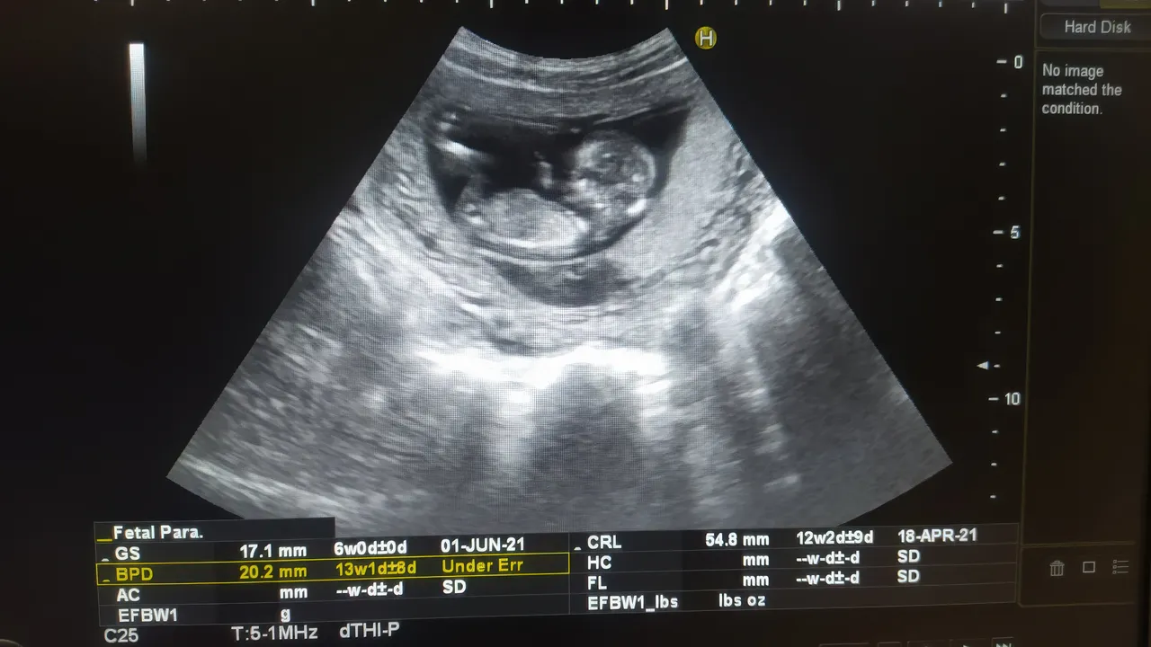 Pfas nei feti, la situazione è più grave di quanto immaginassimo