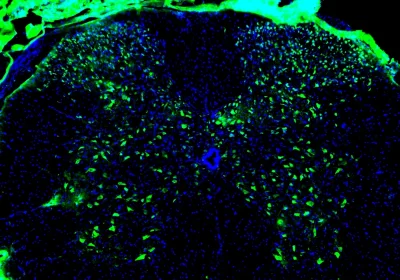 Dallo studio dei tumori spunta una nuova strada per per la riparazione del midollo spinale