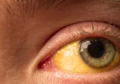 Come si prende l’epatite A e come riconoscere subito i sintomi della malattia che sta provocando focolai in diverse regioni d’Italia