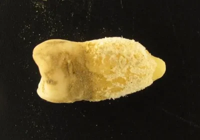 Un batterio scoperto su un dente di mummia boliviana riscrive la storia della scarlattina e oltre